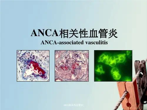 ANCA相关性血管炎
