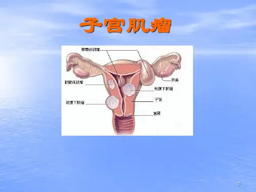 子宫肌瘤ppt课件