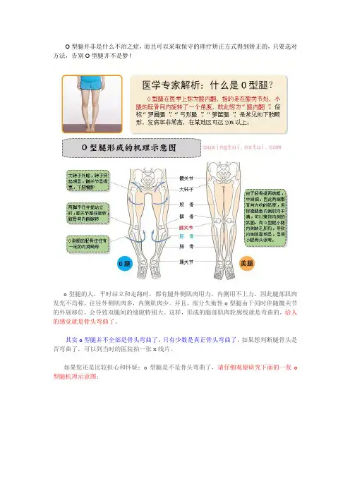 o型腿能矫正好吗