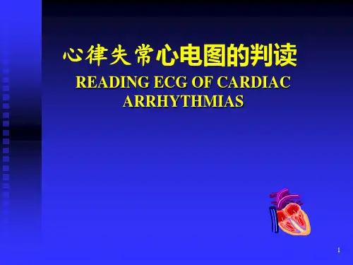 常见心律失常的心电图