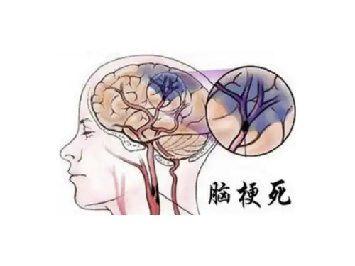 脑梗死MRI表现课件