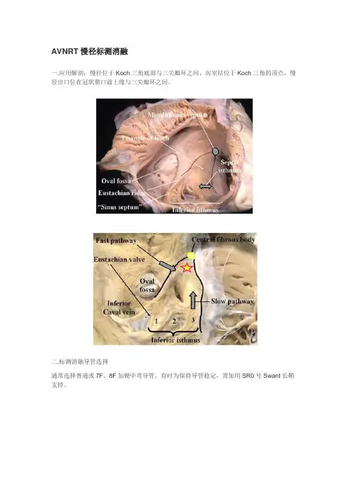 AVNRT慢径标测消融