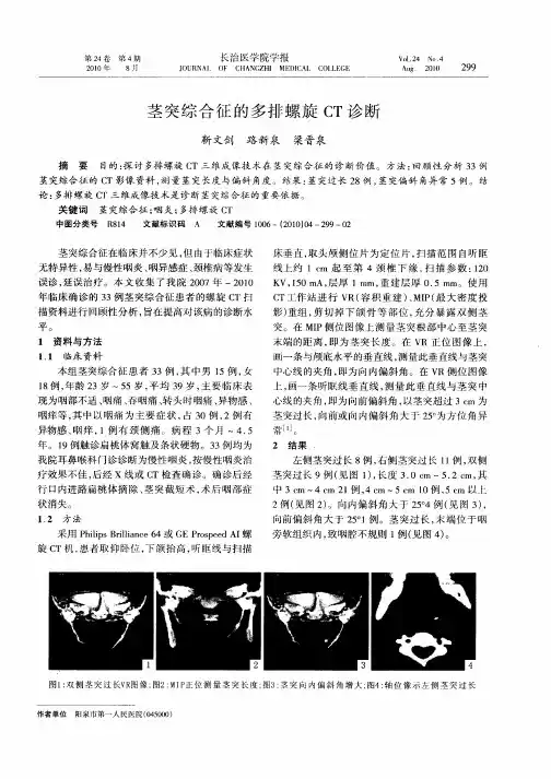 茎突综合征的多排螺旋CT诊断