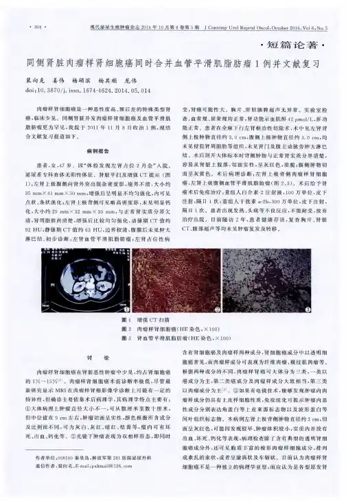 同侧肾脏肉瘤样肾细胞癌同时合并血管平滑肌脂肪瘤1例并文献复习