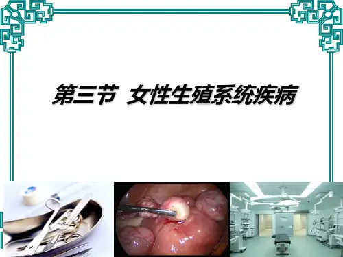 子宫肌瘤.