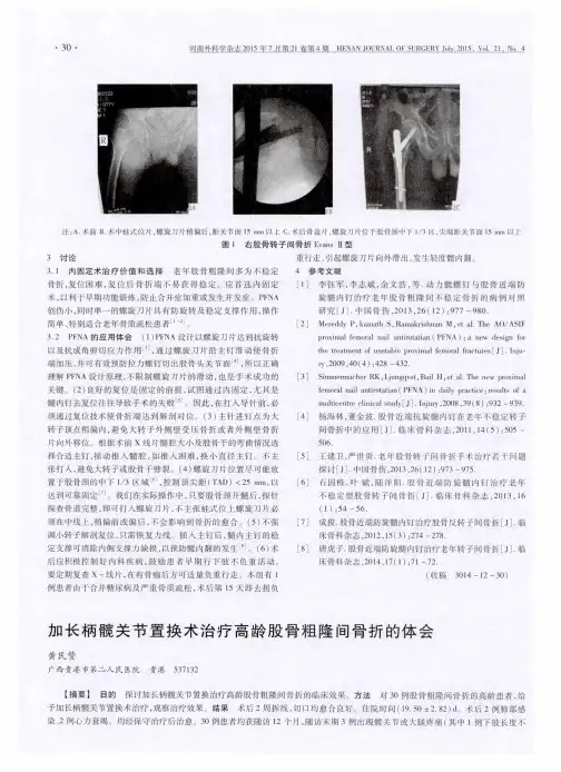 加长柄髋关节置换术治疗高龄股骨粗隆间骨折的体会