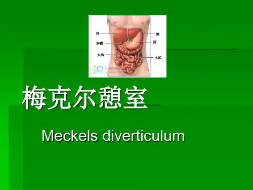 美克尔憩室