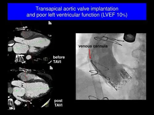 TAVI Screening + LVEF10