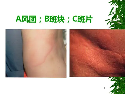 荨麻疹PPT课件