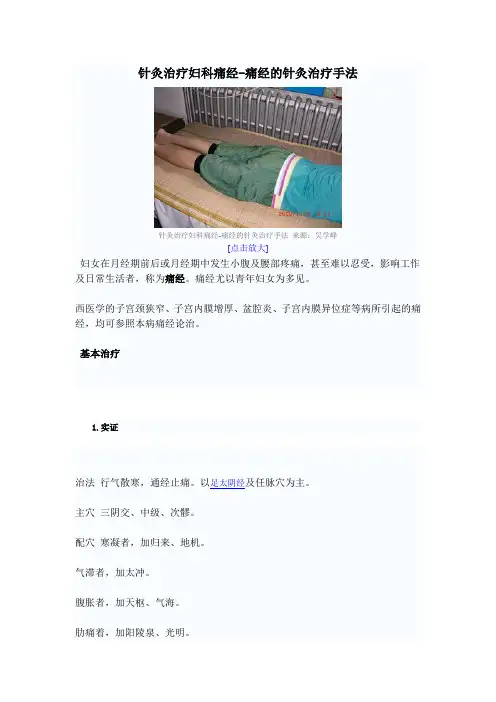 针灸治疗痛经 2