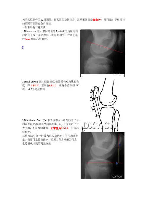 关于高位髌骨的X线测量及诊疗