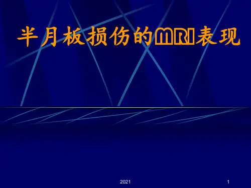 半月板损伤的MRI表现PPT课件