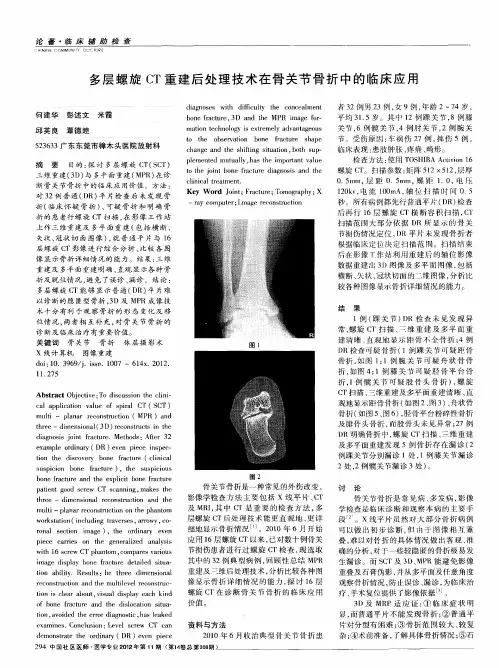 多层螺旋CT重建后处理技术在骨关节骨折中的临床应用