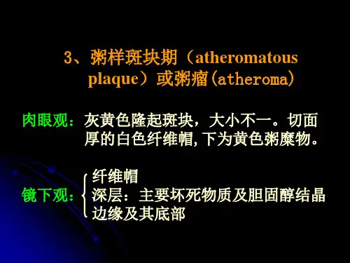 病理学动脉粥样硬化症中部分