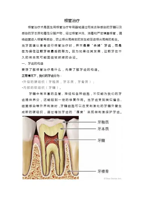 根管治疗