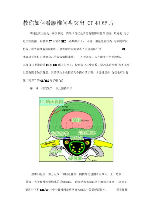 教你如何看腰椎间盘突出CT和MR片