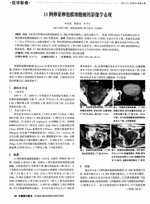 13例卵巢卵泡膜细胞瘤的影像学表现