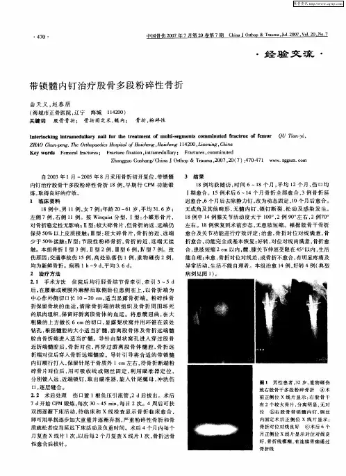 带锁髓内钉治疗股骨多段粉碎性骨折