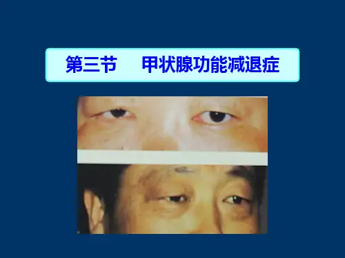 甲状腺功能减退的护理ppt课件