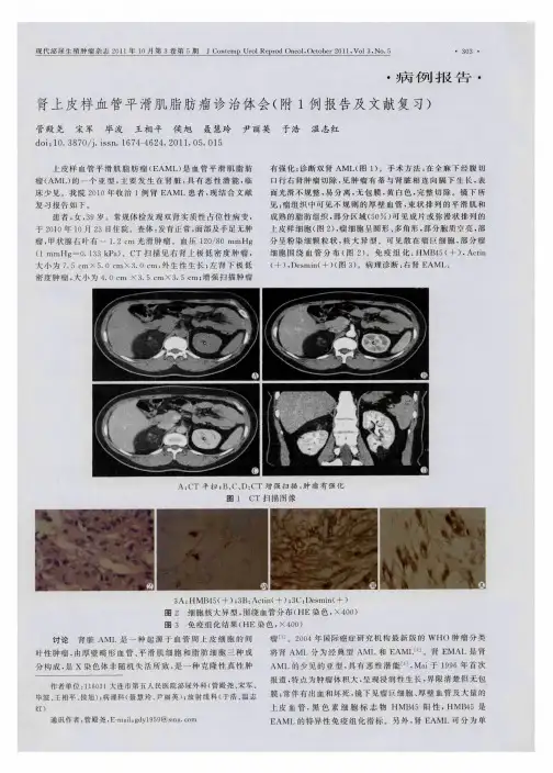 肾上皮样血管平滑肌脂肪瘤诊治体会(附1例报告及文献复习)