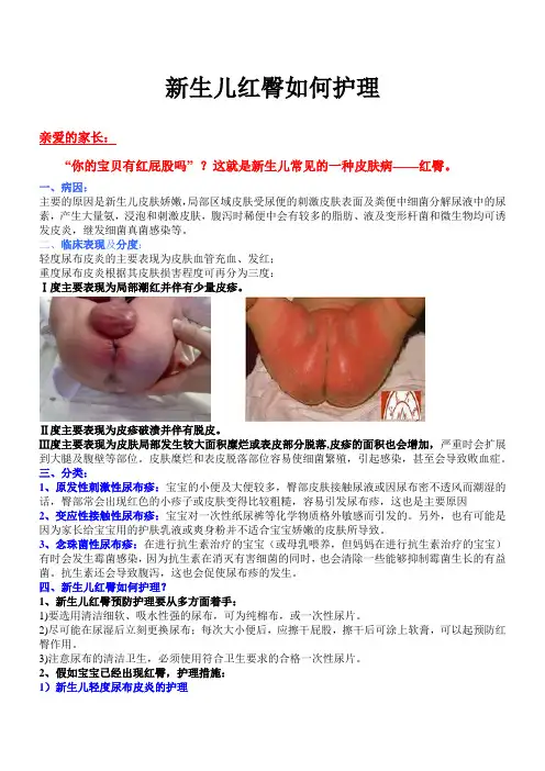 新生儿红臀如何护理