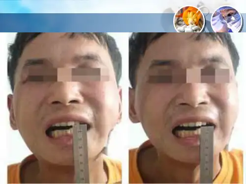 鼻咽癌患者放疗后的张口锻炼ppt课件