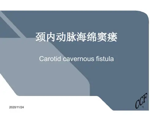 颈内动脉海绵窦瘘 ppt课件