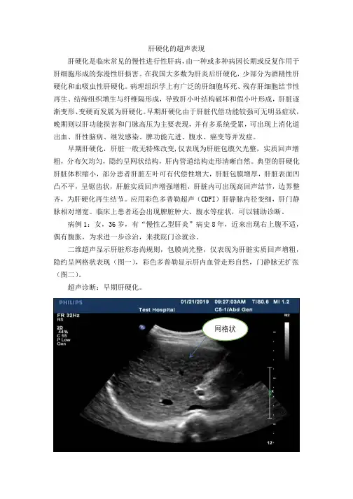 肝硬化的超声表现