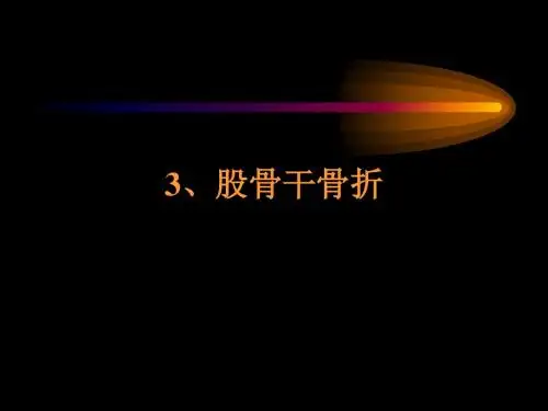 3、股骨干骨折