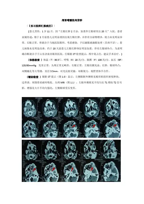 嗜酸性肉芽肿
