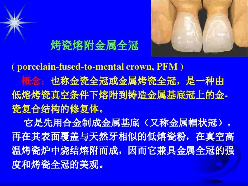 烤瓷熔附金属全冠PPT课件
