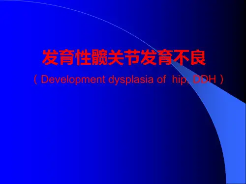 发育性髋关节发育不良