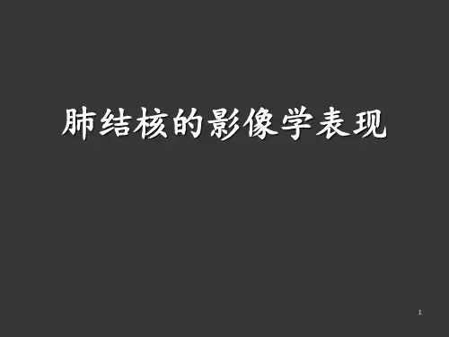 肺结核影像学表现ppt课件